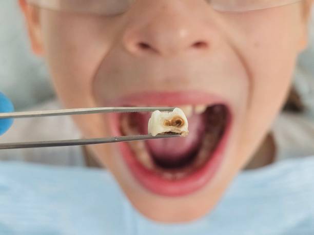 Best Emergency Tooth Extraction in Windham, OH